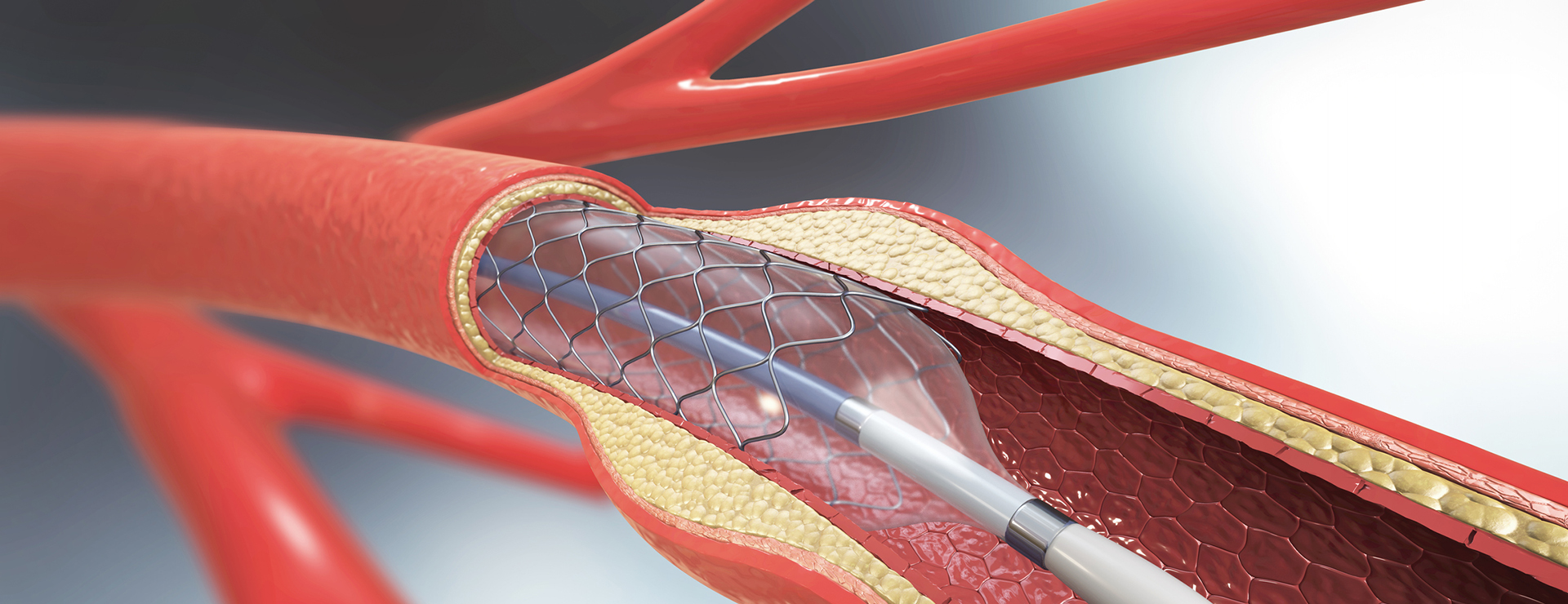 Angioplasty And Stent Placement For The Heart | Johns Hopkins Medicine