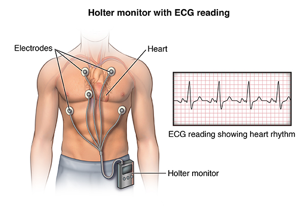 holter-monitor-johns-hopkins-medicine