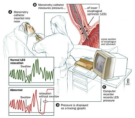 Esophageal Manometry | Johns Hopkins Medicine