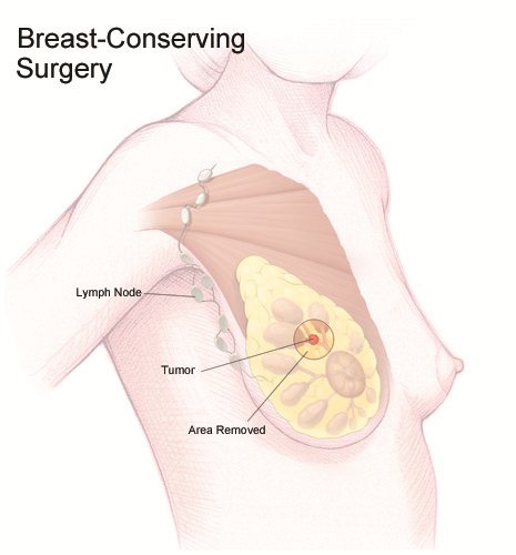 Physical Therapy Helps Breast Cancer Surgery Recovery