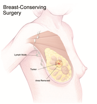 Techniques for overcoming a missing clip during pre-operative needle  localization for lumpectomy: case report - Johnson - Annals of Breast  Surgery