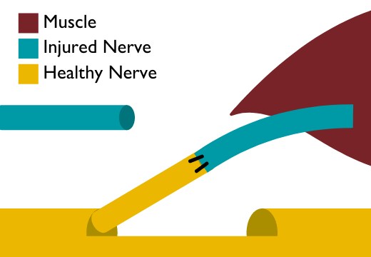 Nerve Transfer | Johns Hopkins Medicine