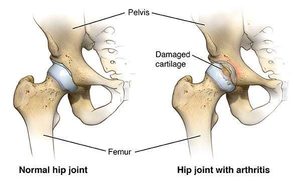 Hip Arthritis Johns Hopkins Medicine