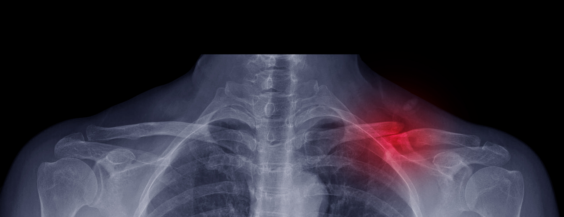 Clavicle Fracture Open Reduction and Internal Fixation Johns