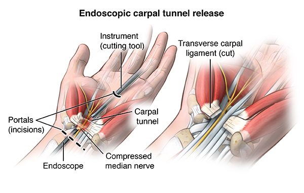 Unlocking Relief: Best Carpal Tunnel Release Surgery at TX