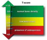 Understanding Bone Density Scan Results If You're Younger