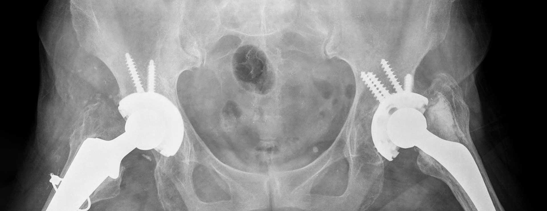 Hip Replacement Surgery | Johns Hopkins Medicine