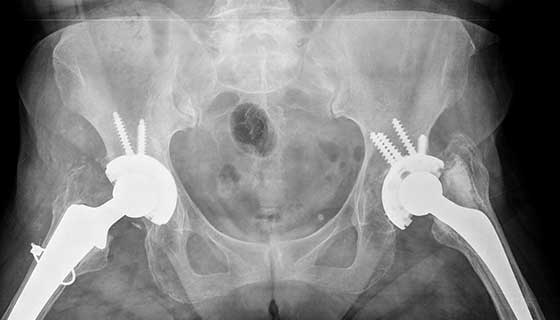 Is your hip replacement surgery medically necessary? How can you