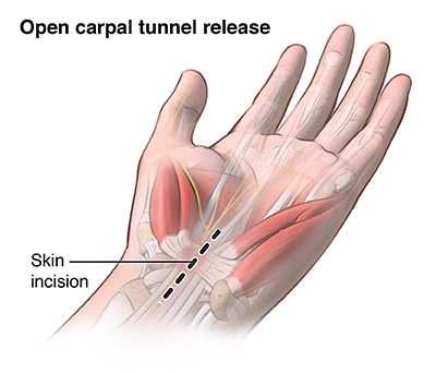 Carpal tunnel surgical procedure: MedlinePlus Medical Encyclopedia Image