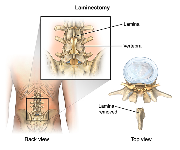 How to Sleep after Back Surgery  Spinal fusion, Spinal fracture,  Laminectomy, Back injury 