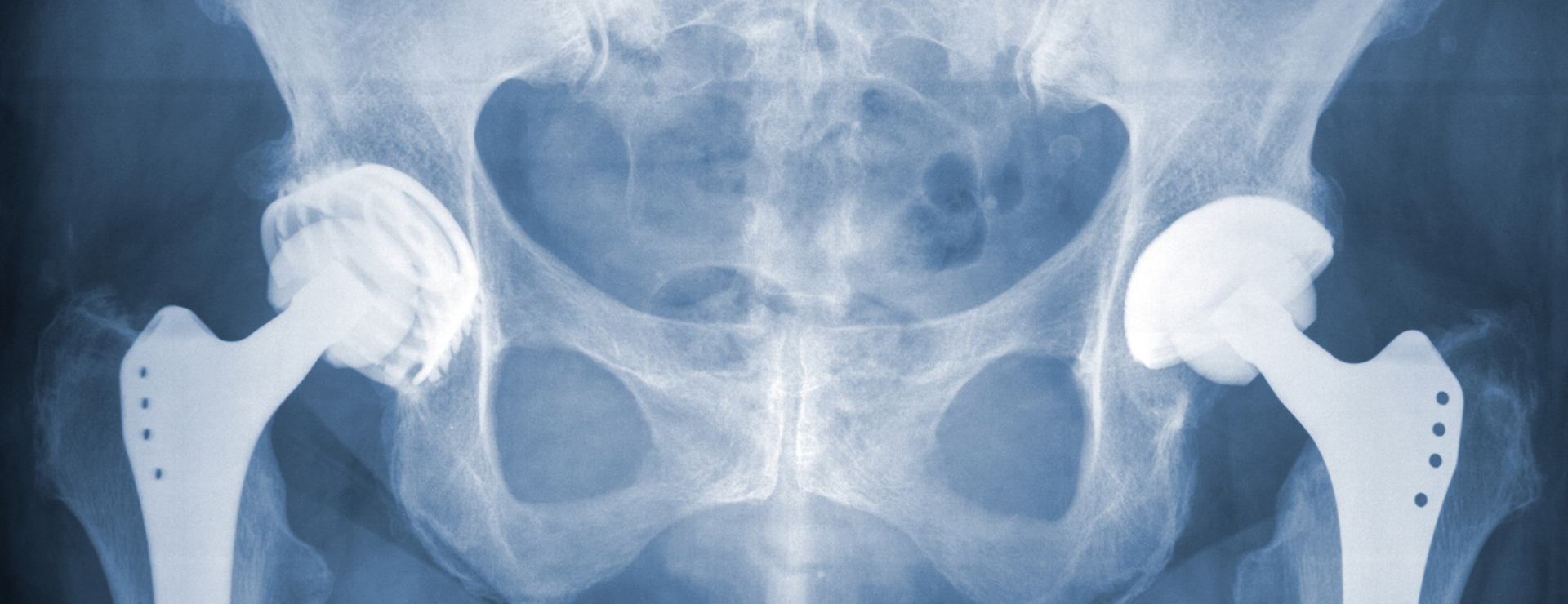 Right Hip Arthroplasty