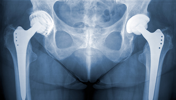 Total Hip Replacement Anterior Approach Johns Hopkins Medicine