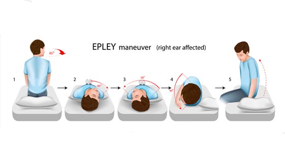 Graphic of the Epely Maneuver