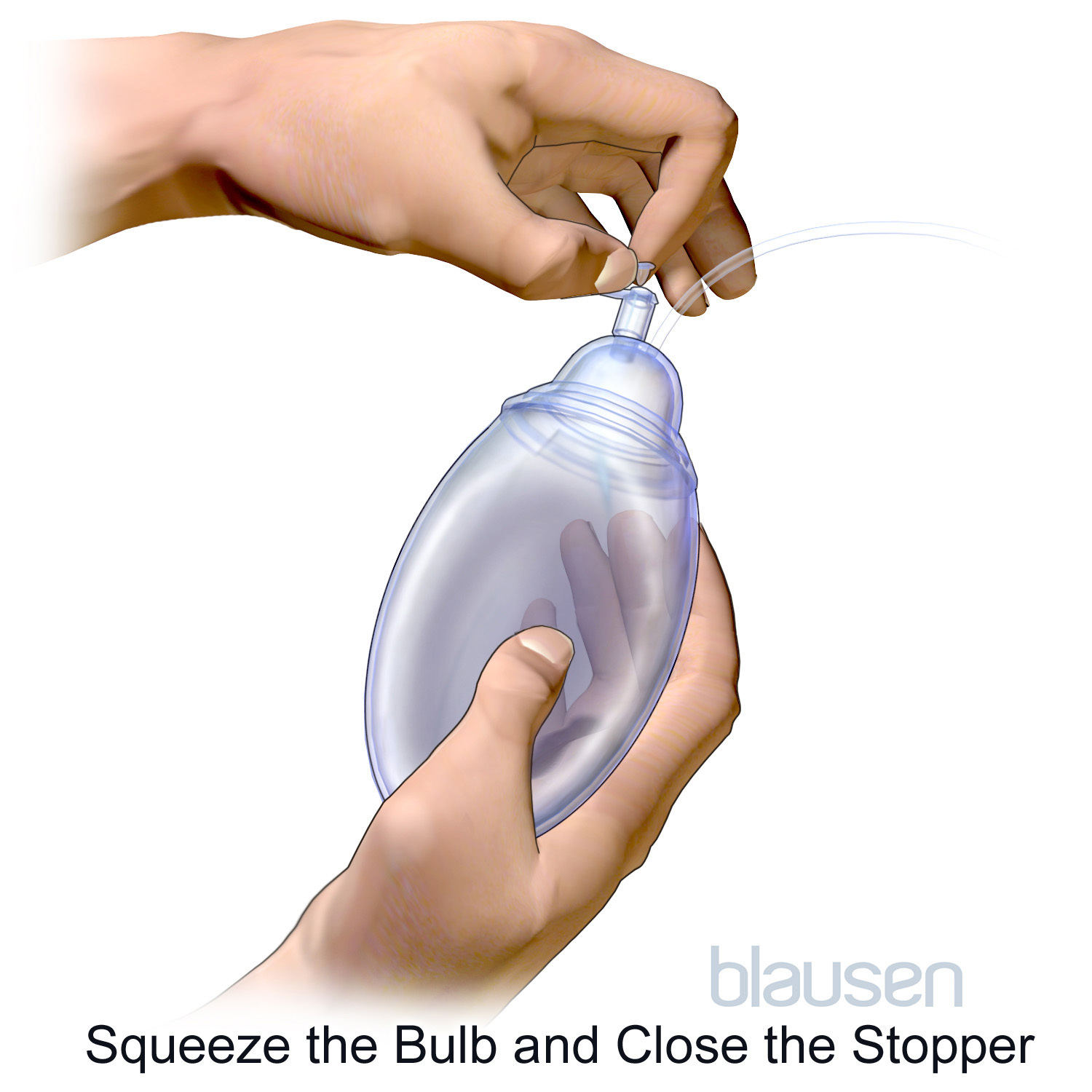 A graphic showing how to close the stopper of a Jackson-Pratt drain.