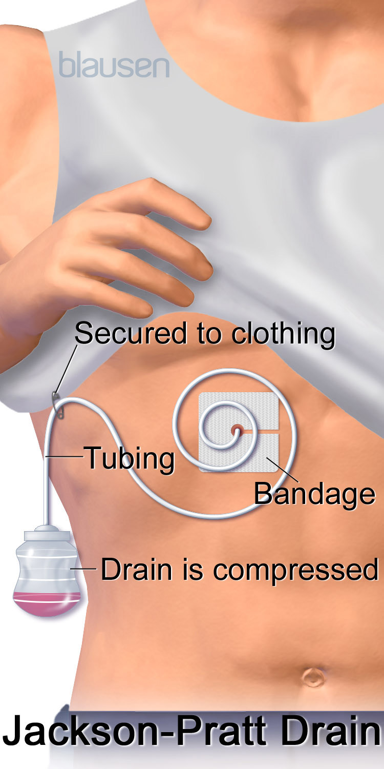 A graphic showing how a Jackson-Pratt drain works.