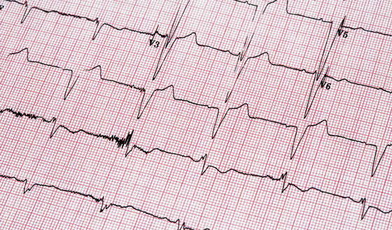 maze-procedure-afib-surgery-johns-hopkins-medicine