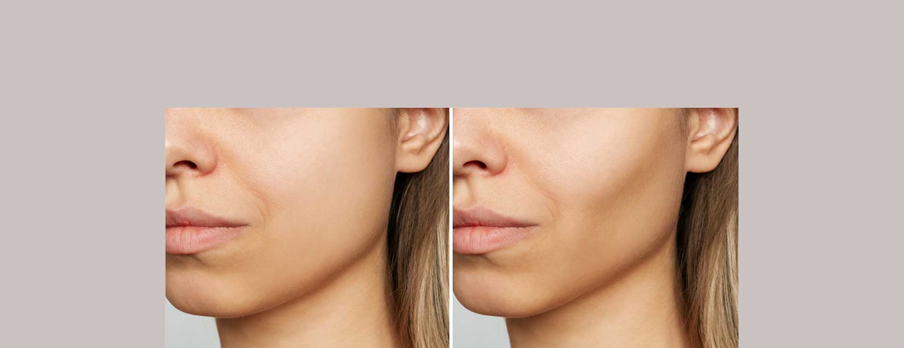 Dr. Nabil Fakih on X: What is Buccal Fat Pad Removal? Slim your face by  Buccal fat pad removal. By removing the Buccal fat pad your cheeks will be  more prominent and