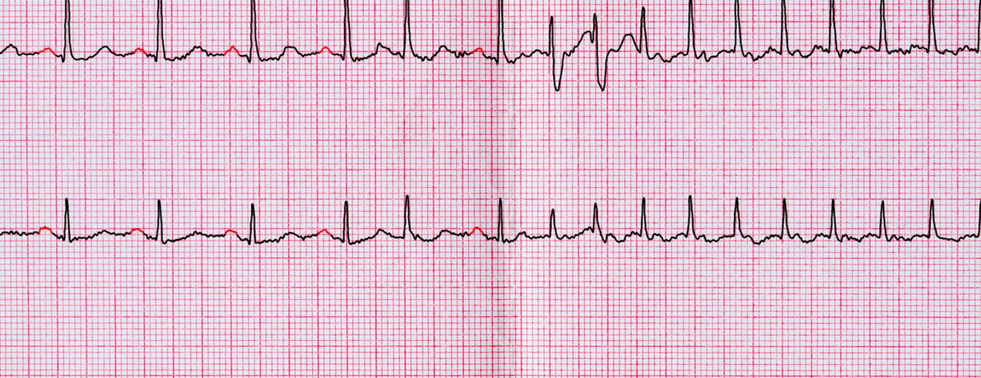 Heart Rhythms What s Normal Versus Cause for Concern Johns