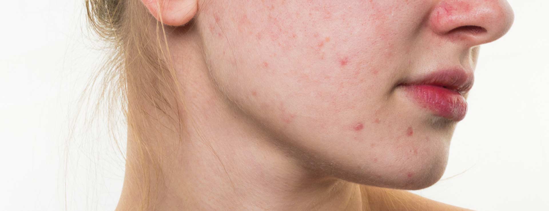 Got Adult Acne Get Answers from an Expert Johns Hopkins Medicine