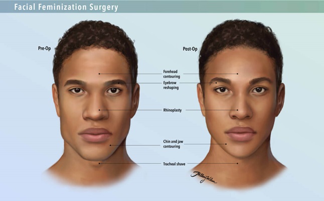Facial Feminization Surgery Ffs Johns Hopkins Medicine