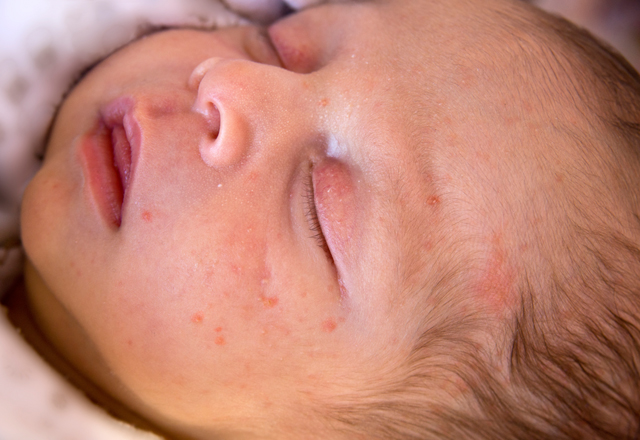 Newborn Skin 101 | Johns Hopkins Medicine