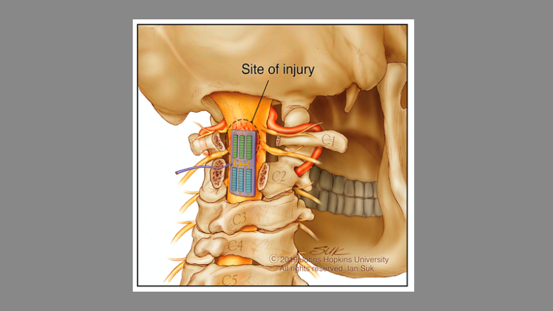 Surgical Spinal Cord Stimulation Orange County