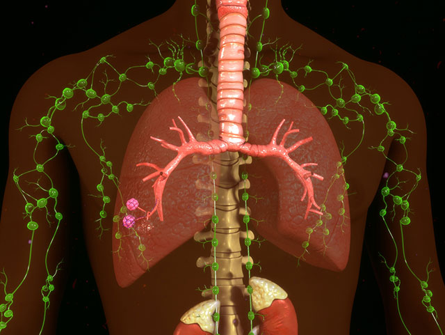 Breast Cancer Lymphedema After Treatment Johns Hopkins Medicine