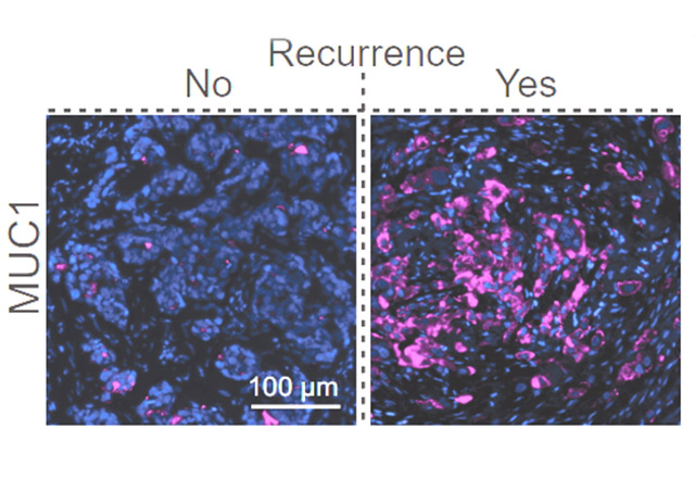 Sixteen genes help cancer cells leave the low-oxygen region of tumors and survive in the bloodstream. One – MUC1 (purple) – is in clinical trials to reduce cancer recurrence. 