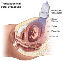 achondroplasia ultrasound