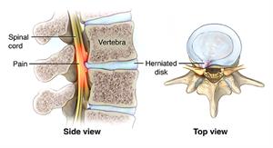 Spinal Cord Compression Johns Hopkins Medicine