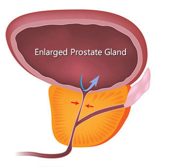 Solved Benign prostatic hypertrophy (BPH) is a fairly common