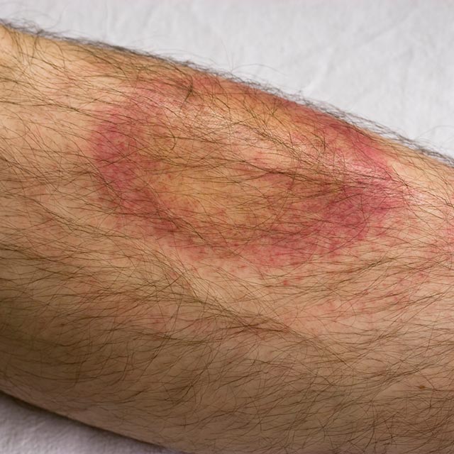 tick bite lyme disease