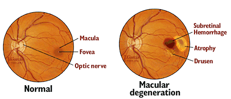 Macular Degeneration Testing, Eye Care
