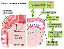 Collagenous And Lymphocytic Colitis Johns Hopkins Medicine