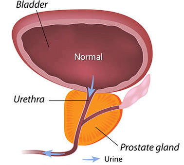 Benign Prostatic Hyperplasia BPH Johns Hopkins Medicine