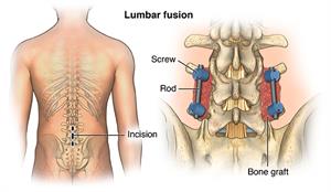 Long Term Effects of Spinal Cord Compression –
