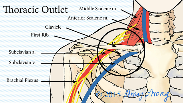 Vascular Thoracic Outlet Syndrome - Sports Medicine Review