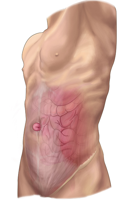 How to Tell If You Have a Pulled Abdominal Muscle or Hernia - Baptist Health
