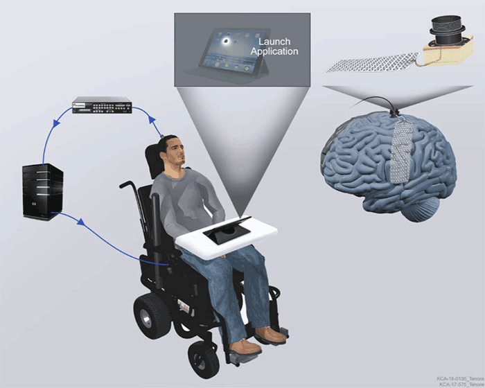 Brain-Computer Interface Clinical Trials | Johns Hopkins Neurology And ...