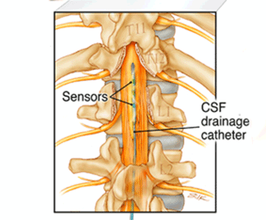 Diagram of a drainage catheter in the spine.