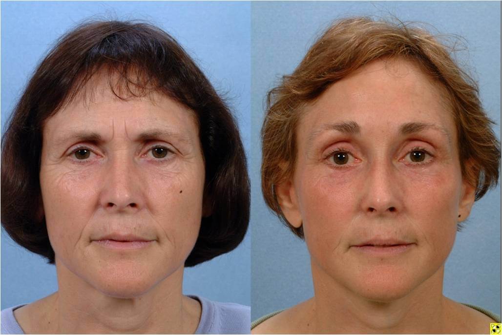 Face Lift | Johns Hopkins Facial Cosmetic Surgery