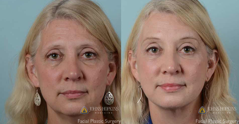 Neck Lift Johns Hopkins Medicine   Facelift Before And After 3 