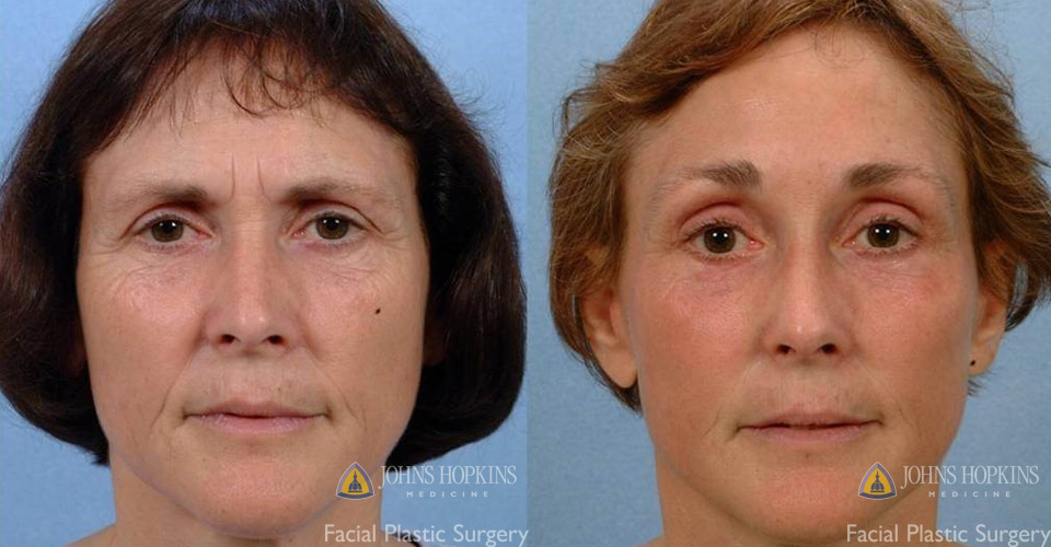 Neck Lift Johns Hopkins Medicine   Faceliftbeforeandafter1 