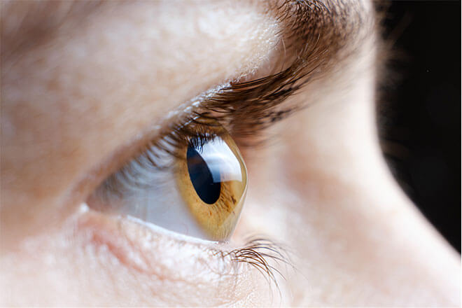 A close up of a woman with an abnormal cornea.