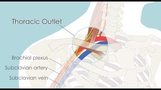 Thoracic outlet syndrome - Symptoms and causes - Mayo Clinic