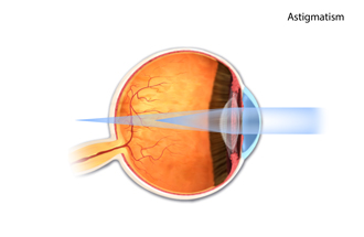 Astigmatism