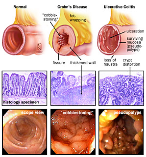 Crohn S Disease Johns Hopkins Medicine   Comparisonoftheappearanceofnormalcrohnsandulcerativecolitismuc.ashx