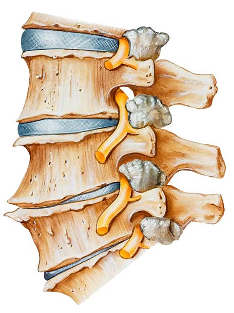 Spinal Arthritis Arthritis In The Back Or Neck Johns Hopkins Medicine