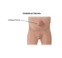 Inguinal and Umbilical Hernia