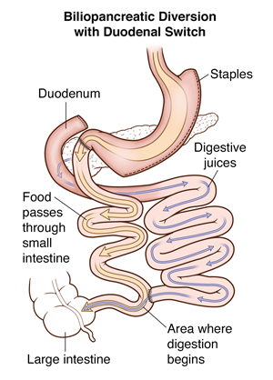 Vista frontal do estômago mostrando desvio biliopancreático com interruptor duodenal. As setas mostram o caminho dos alimentos e fluidos digestivos.